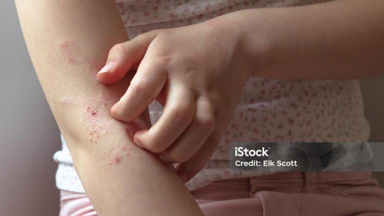 Süt Alerjisi Belirtileri Nelerdir? Süt Alerjisi Nasıl Anlaşılır? Tedavi Yöntemleri Nelerdir?